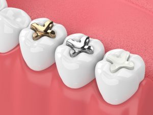 Ceramic Fillings