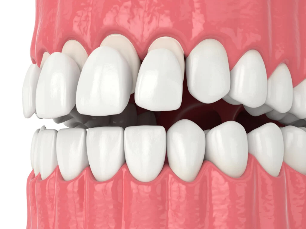 Composite Veneers