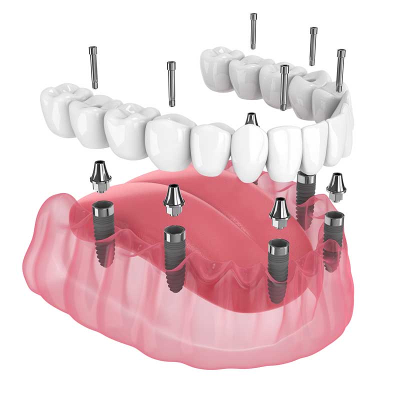 Full Arch Implants