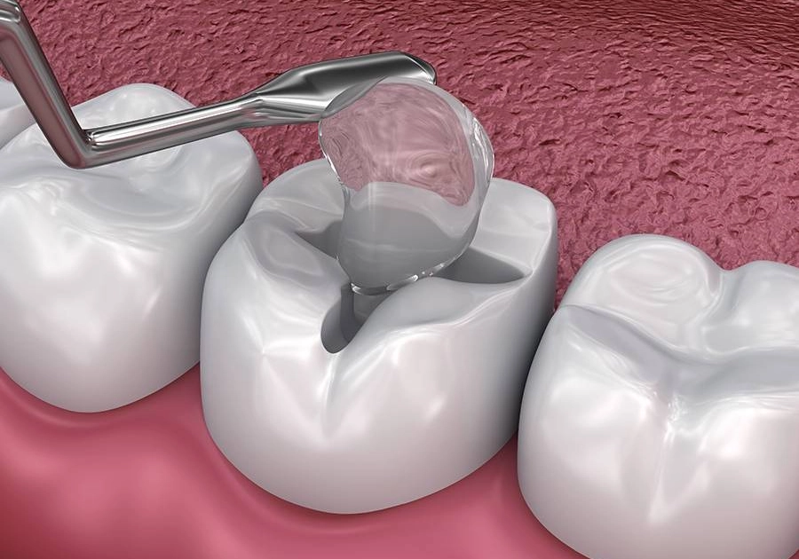 Glass Ionomer Fillings