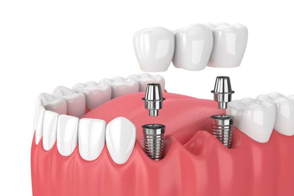 Multiple Teeth Implants