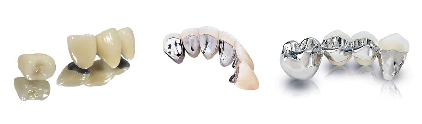 Porcelain-Fused-to-Metal Crowns