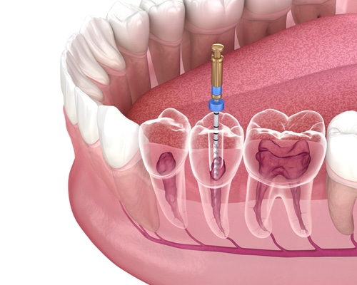 Single Visit Root Canal Procedure