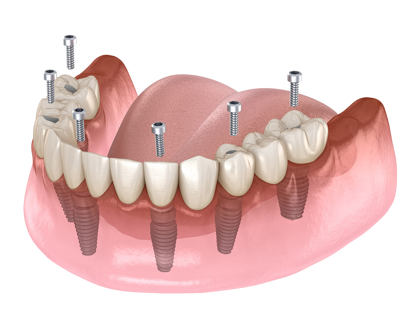 All-on-4 Dental Implants