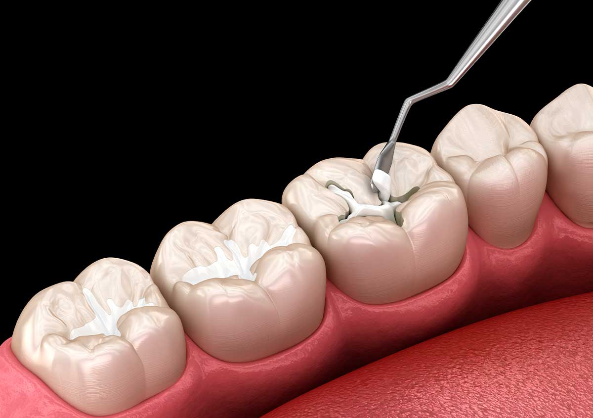 Composite Resin Fillings