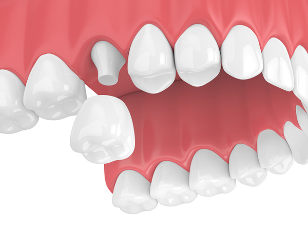 Porcelain Crowns